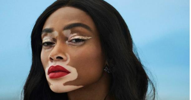 Сьогодні, 25 червня, відзначають Всесвітній день вітиліго